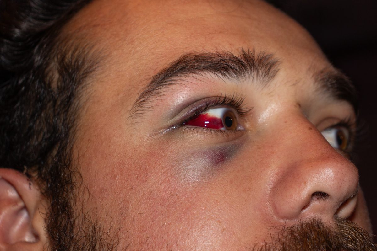 Senior men’s club rugby Winger Declan Coles got sat on during a tackle; multiple blood vessels burst in his eye.